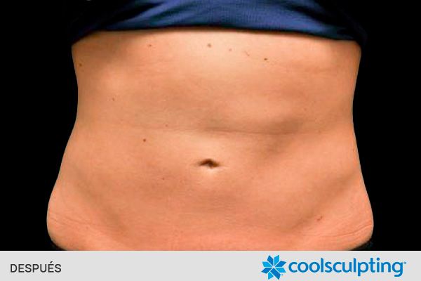 Resultados tratamiento CoolSculpting