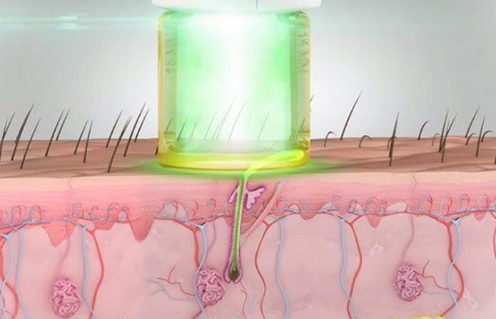 depilacion laser gentlemaxpro