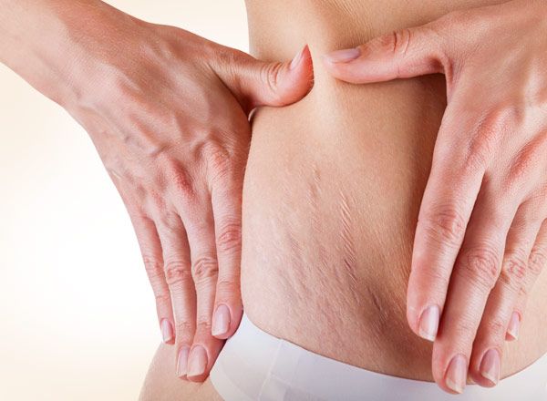 estrias_tratamientos_RibeClinic