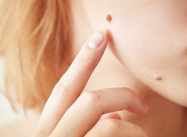 manchas_nevus_tratamientos_RibeClinic