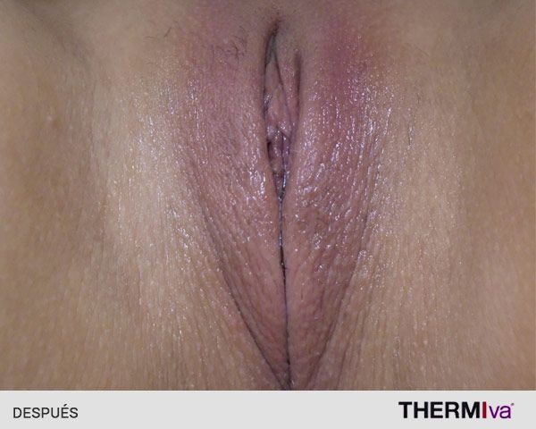 rejuvenecimiento_vaginal_despues