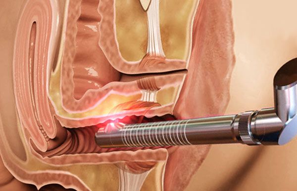 tratamiento laser c02 vaginal