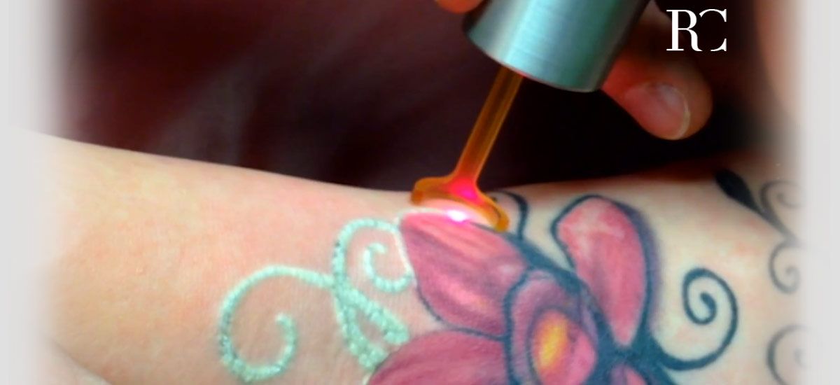 Eliminación de tatuajes con láser