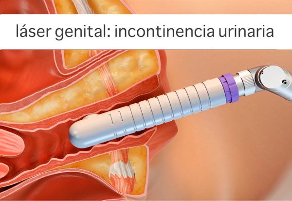 laser genital incontinencia urinaria