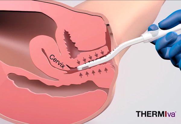tratamiento rejuvenecimiento vaginal RibeClinic