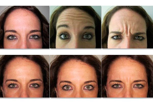 arrugas expresion botox