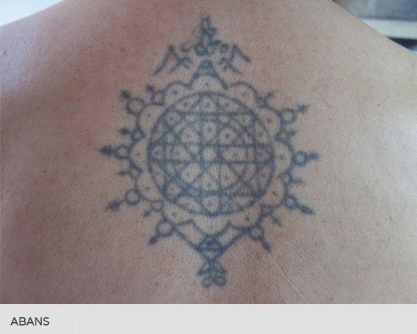 eliminar tatuatges abans i despres