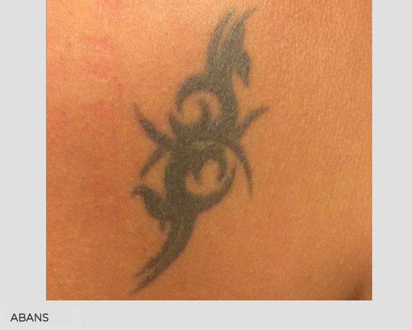 eliminar tatuatges abans despres
