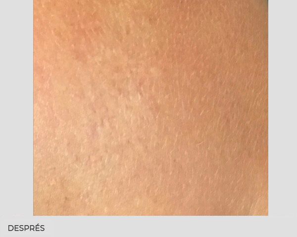 eliminar tatuatges abans despres