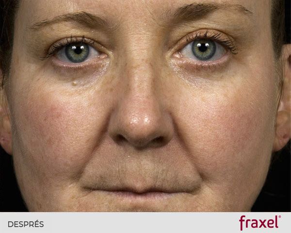 laser_fraxel_luminosidad DESPRES ribe_clinic