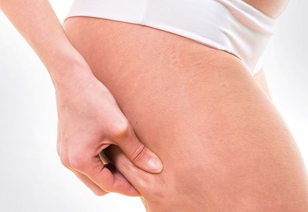 dieta específica, complementos nutricionales, deporte y cremas anticelulíticas para eliminar la celulitis