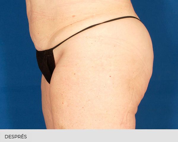 velashape 3 després