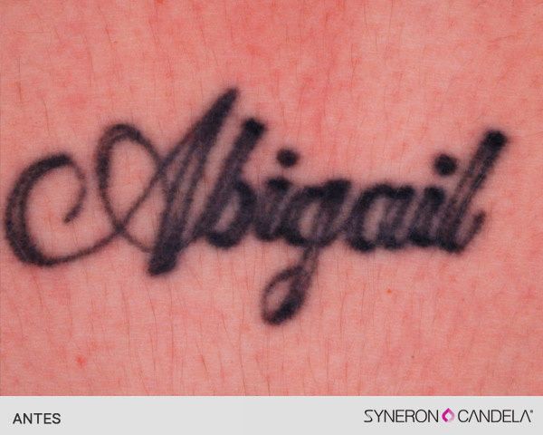 eliminar tatuajes laser antes