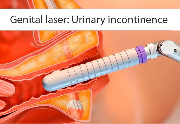 laser genital incontinencia urinaria