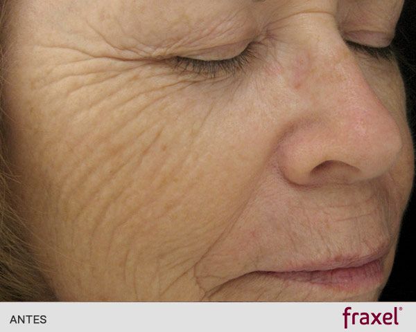 Laser fraxel para las arrugas: ANTES
