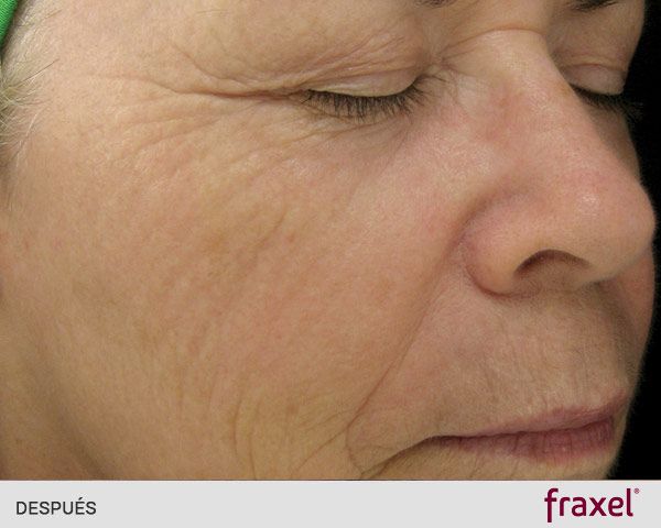 Laser fraxel para las arrugas: DESPUÉS
