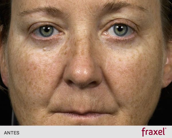 laser_fraxel_luminosidad_antes_ribe_clinic