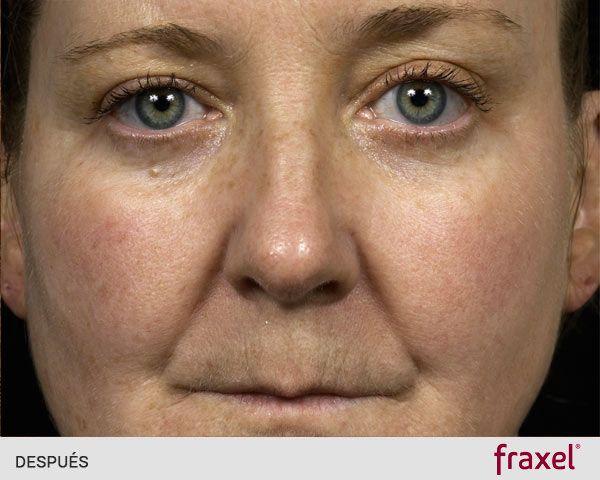 laser_fraxel_luminosidad_despues_ribe_clinic